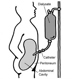 diagram-showing-PD-catheter-in-abdomen